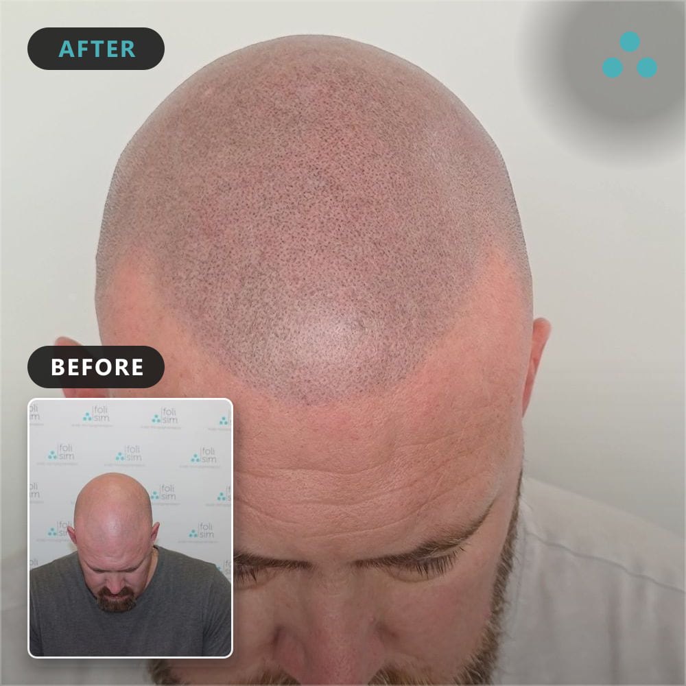 How short should I keep my hair after SMP?