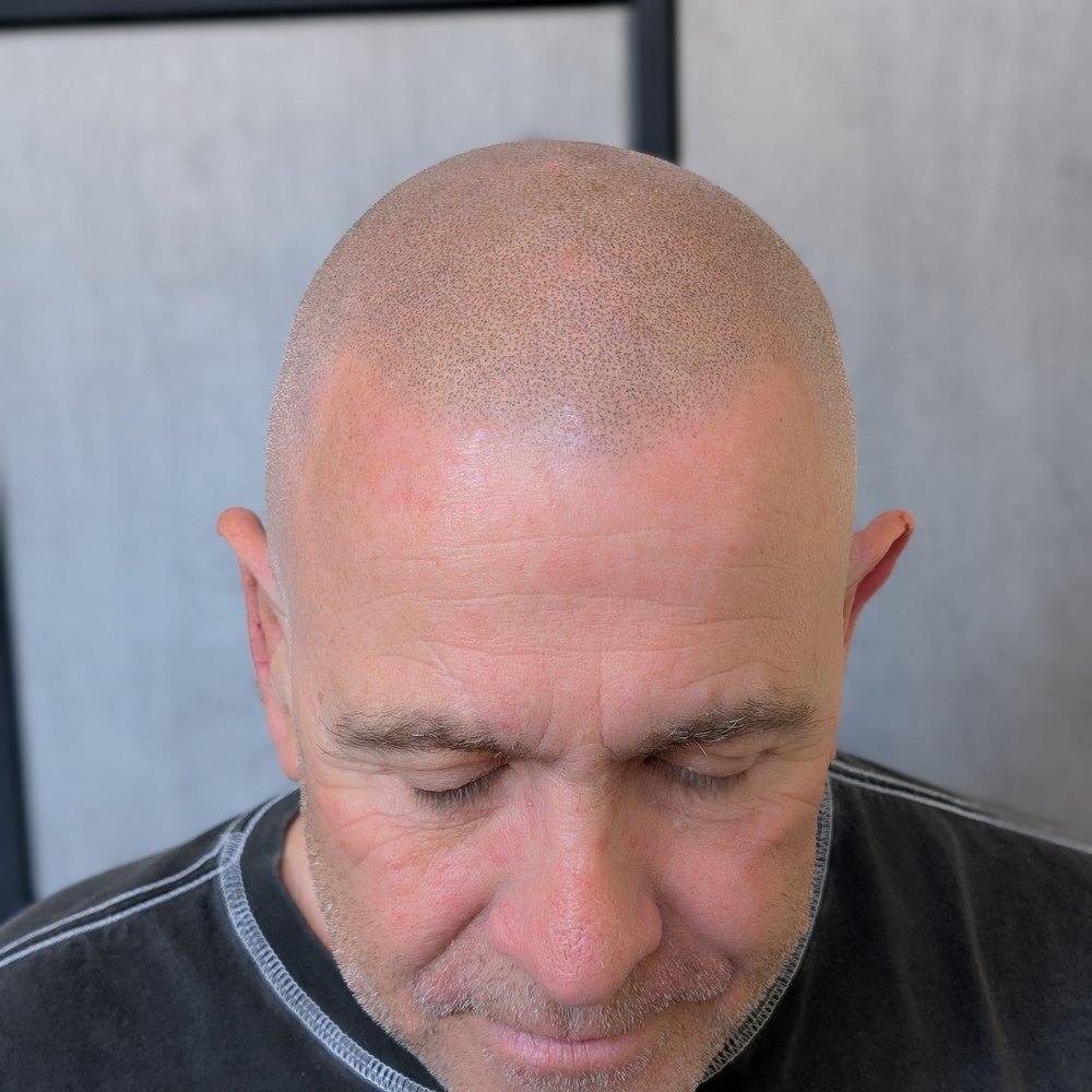Is scalp micropigmentation worth it for a shaved head?