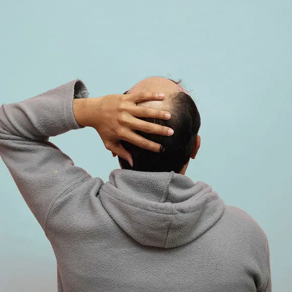 Hair transplant cost Australia