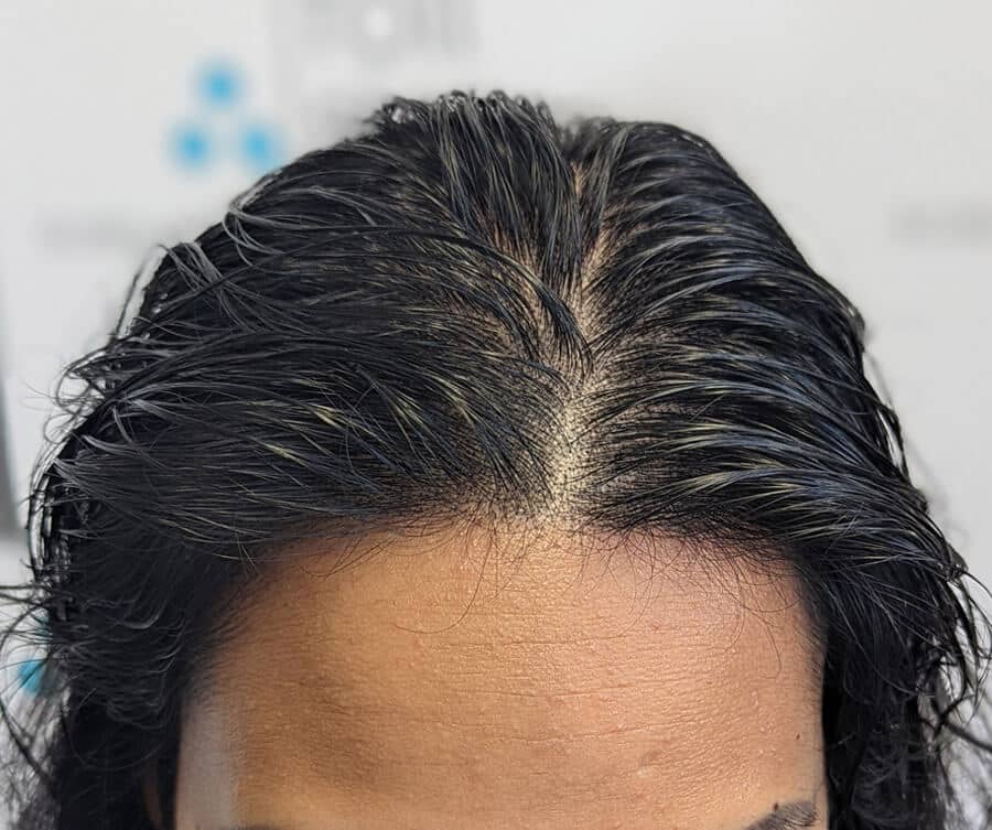 Scalp micro pigmentation women (after), Foli Sim