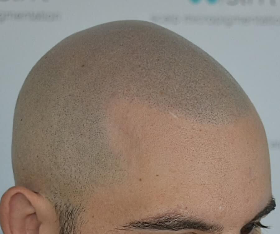 Scalp micropigmentation (after), Foli Sim