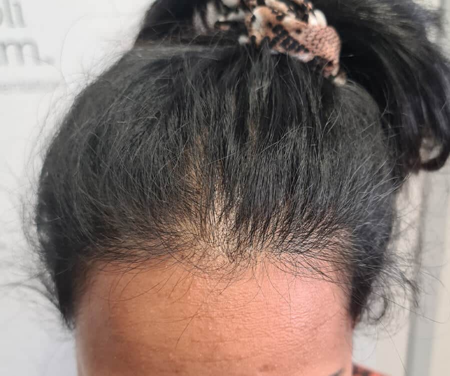 Scalp micro pigmentation women (before), Foli Sim
