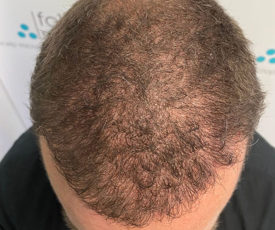 Scalp micropigmentation (before), Foli Sim