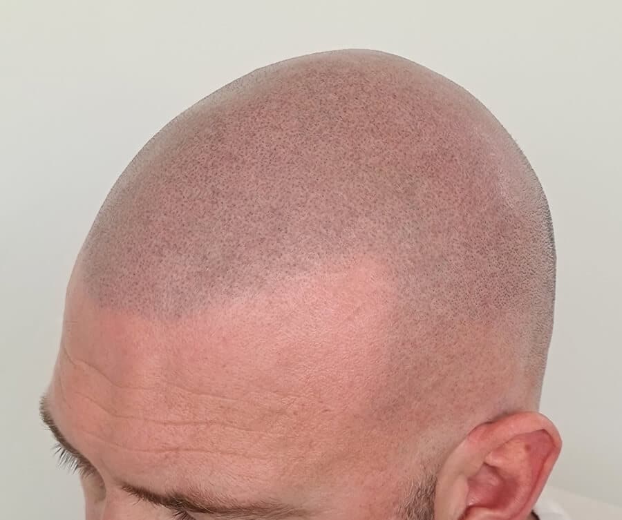 Scalp micropigmentation for buzz cut (after), Foli Sim