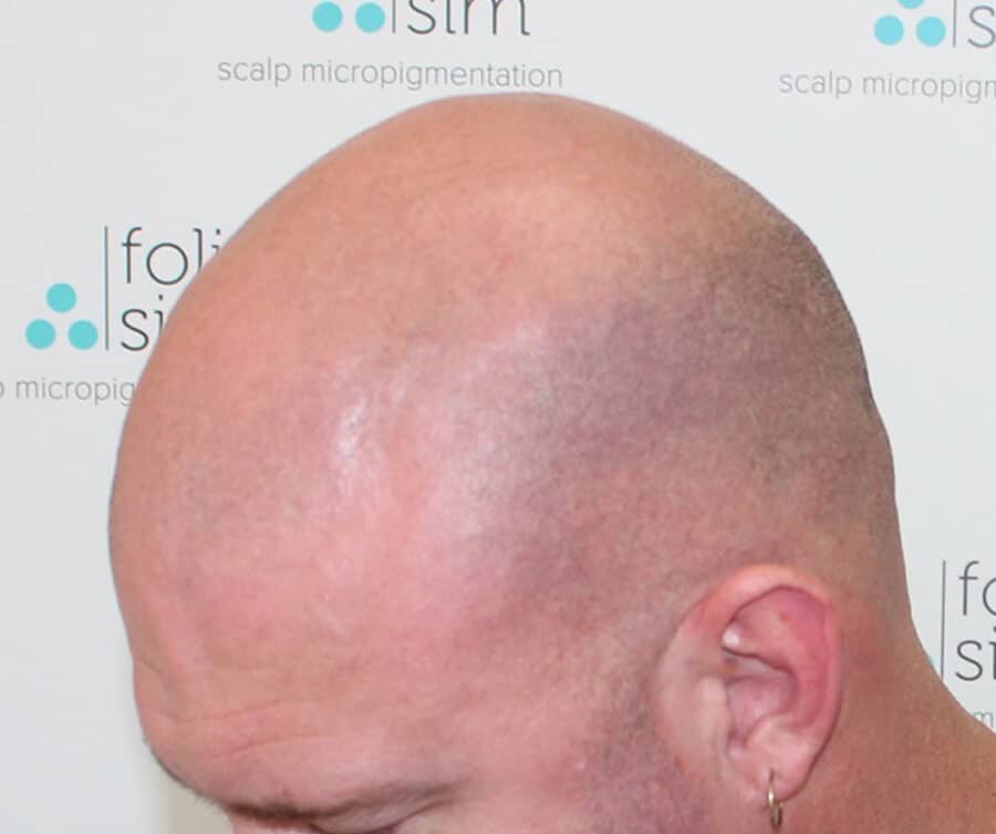 Scalp micropigmentation for buzz cut (before), Foli Sim