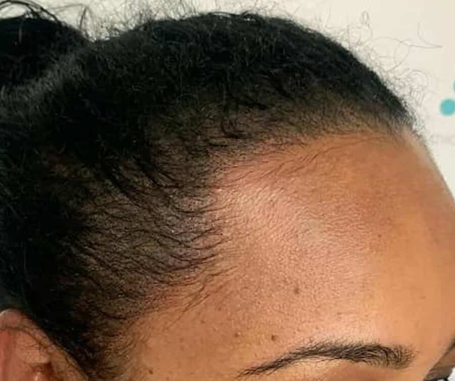 Scalp micropigmentation women (after), Foli Sim