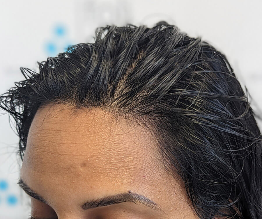 SMP for thinning hair result (after)