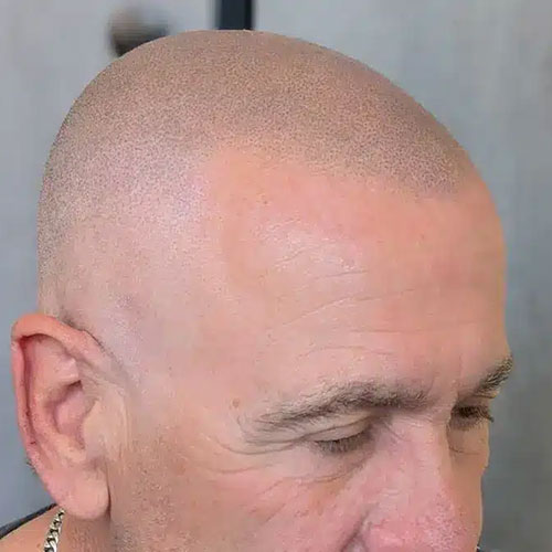 Scalp Micropigmentation Sydney result