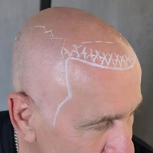 Scalp micropigmentation before, example 6