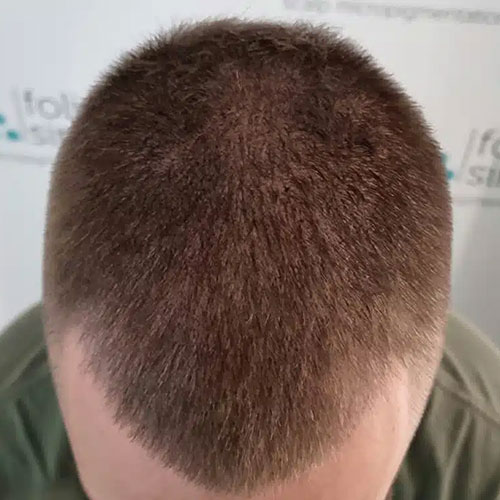 Scalp micropigmentation result, example 3