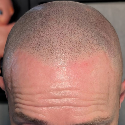 Scalp micropigmentation result, example 4