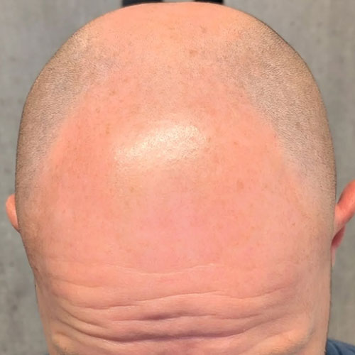 Scalp micropigmentation before, example 4