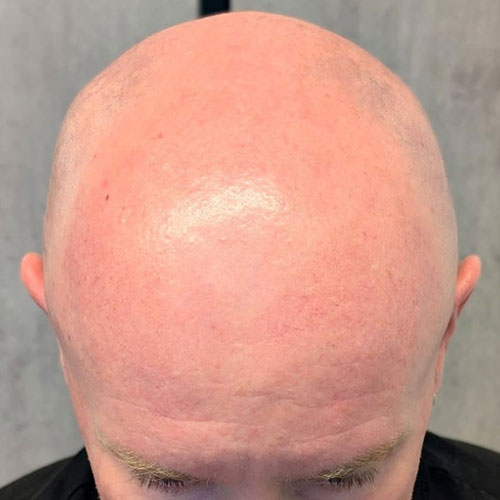 Scalp micropigmentation before, example 1