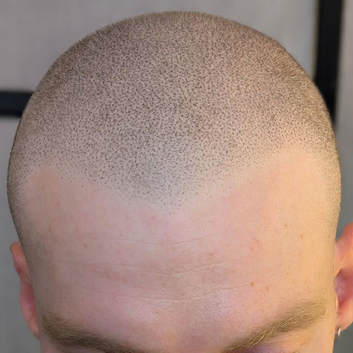 Scalp micropigmentation result, example 2