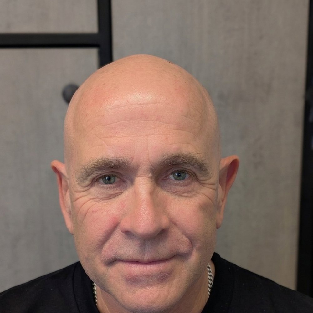 Scalp micropigmentation before, example 5