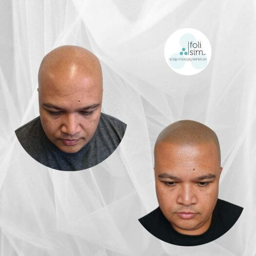 Foli Sim SMP Sydney, Melbourne and Perth - Foli Sim Scalp Micropigmentation