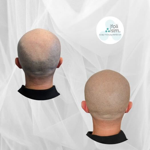 Foli Sim SMP Sydney, Melbourne and Perth - Foli Sim Scalp Micropigmentation (3)