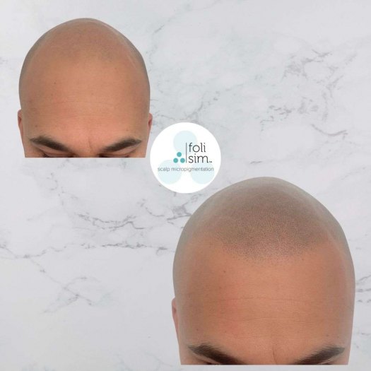 bald hair tattoo