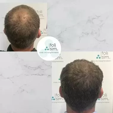 scalp smp treatment