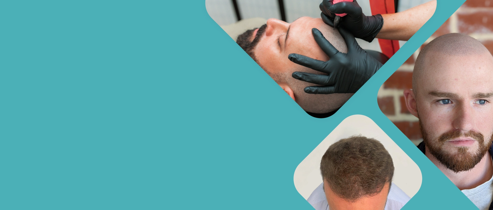 scalp micropigmentation in Australia