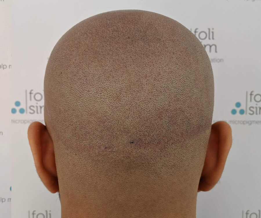 scalp micropigmentation