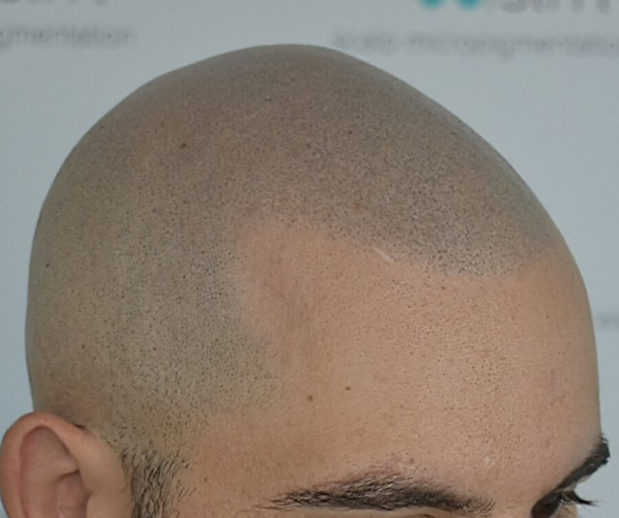 scalp micropigmentation