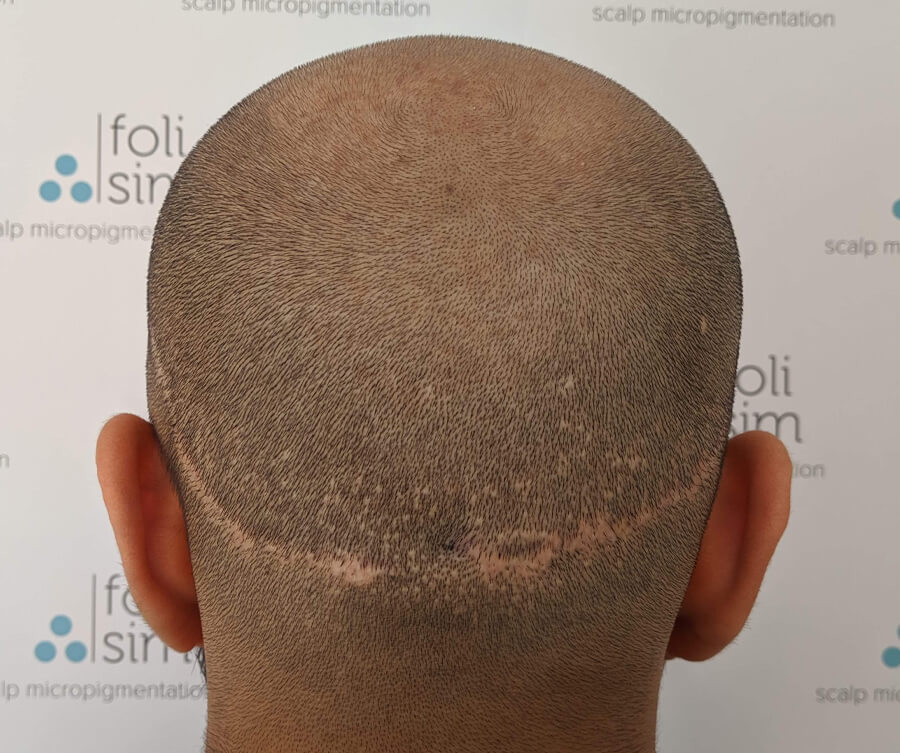 scalp micropigmentation