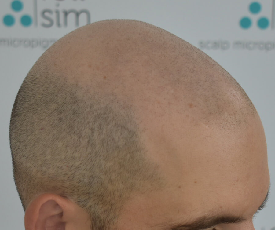 scalp micropigmentation