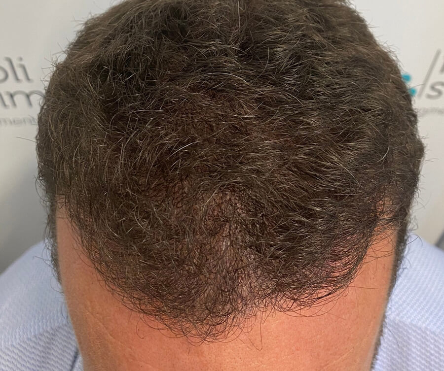 scalp micropigmentation