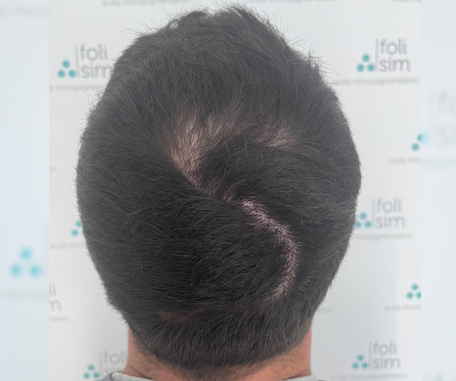 scalp micropigmentation for scars