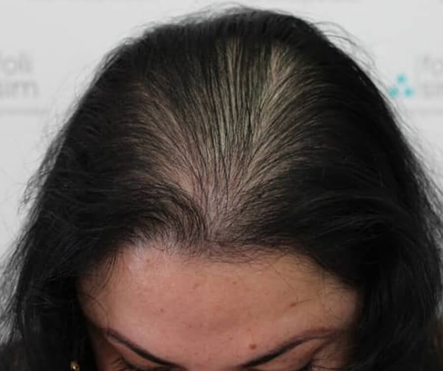 scalp micropigmentation