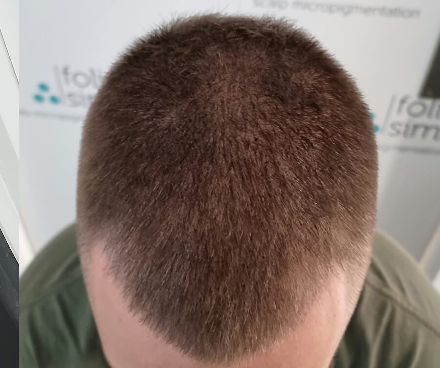 Scalp Micropigmentation Perth