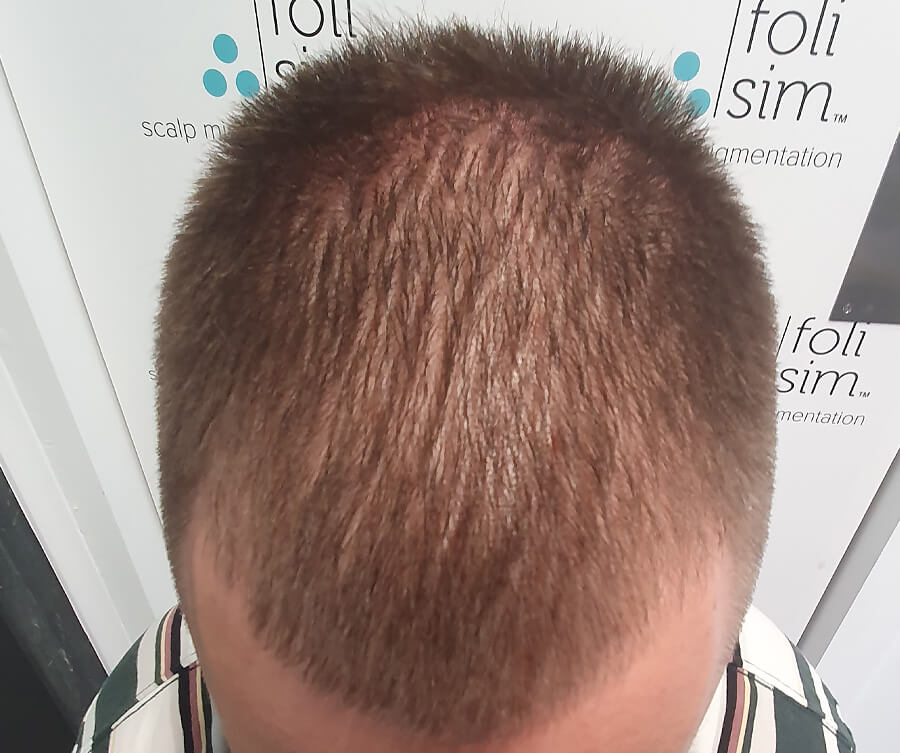 Scalp Micropigmentation Perth