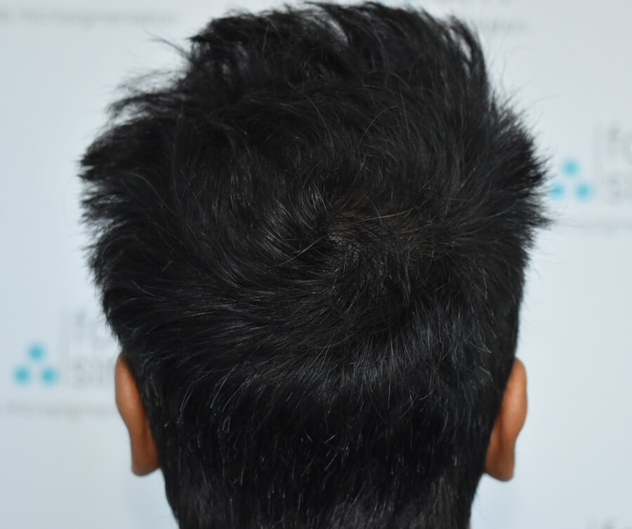 Scalp Micropigmentation Melbourne