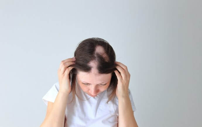 what causes alopecia