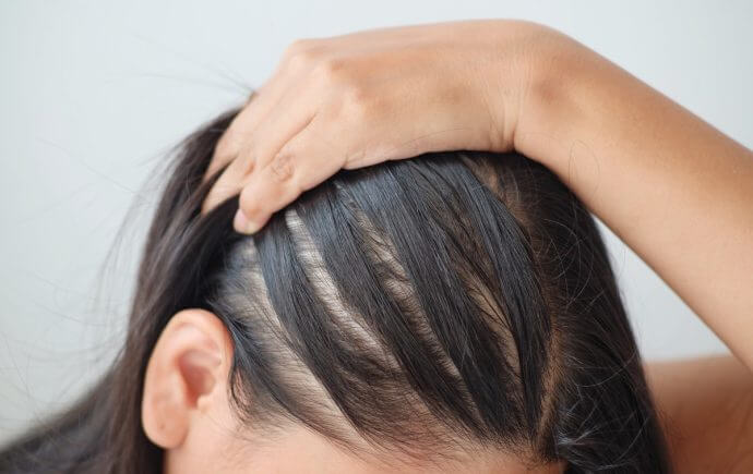 Understanding the Causes of Hair Loss in Women