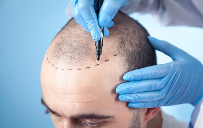 Latest Hair Loss Treatments - smp