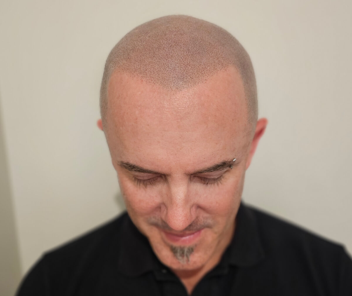 Scalp Micropigmentation Melbourne