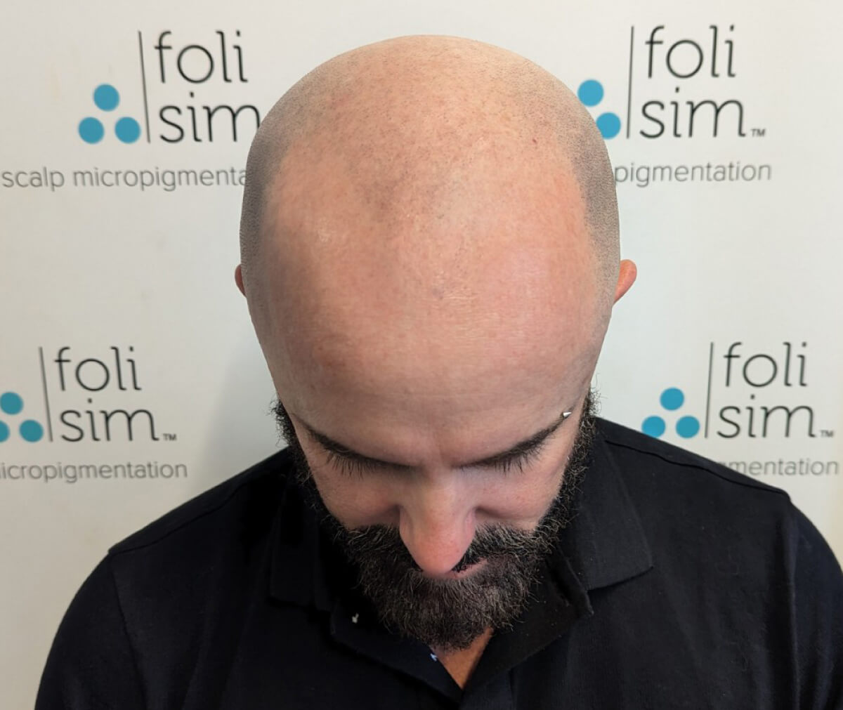 Scalp Micropigmentation Melbourne