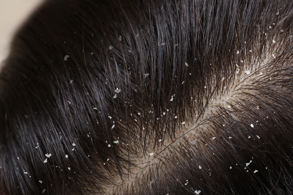 Dandruff and flakiness