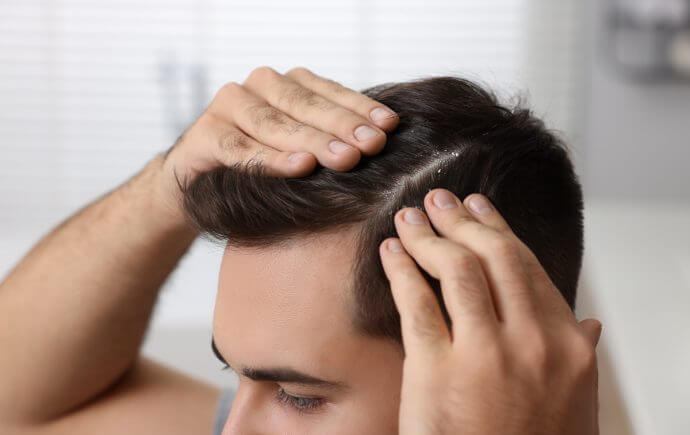 does dandruff cause hair loss