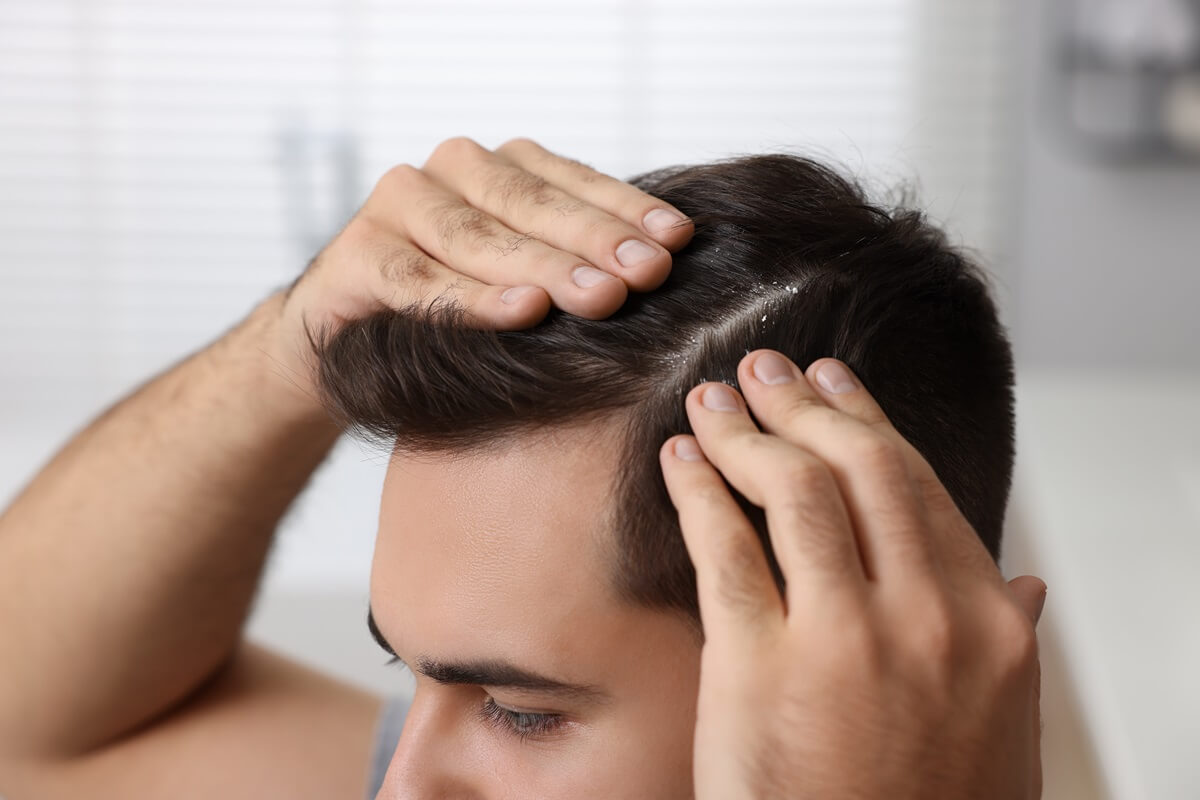 does dandruff cause hair loss