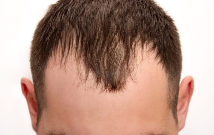 how to combat a receding hairline