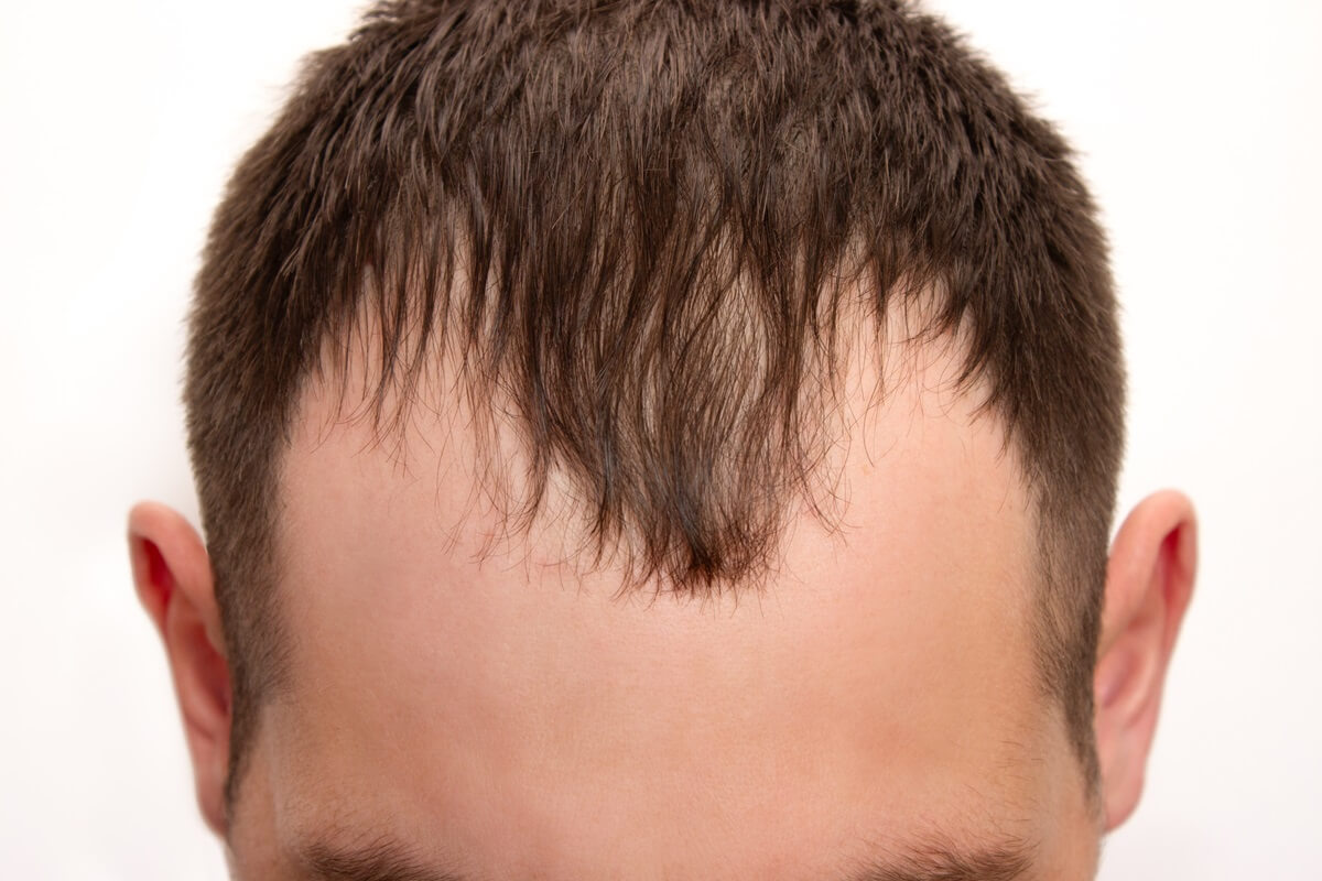 how to combat a receding hairline