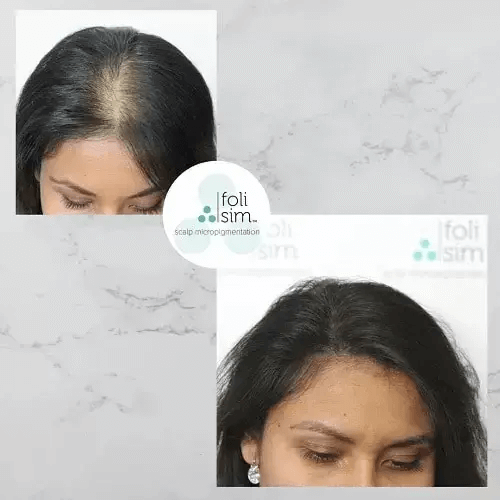 Benefits of SMP for hair density