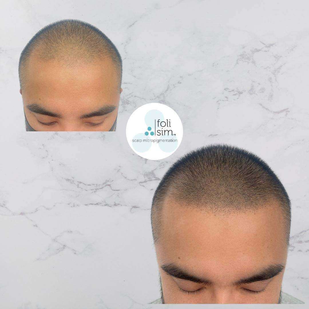 Non-invasive solutions for M-Shaped Hairline