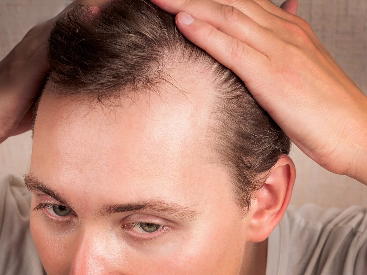 Stress and lifestyle factors - M-Shaped Hairline