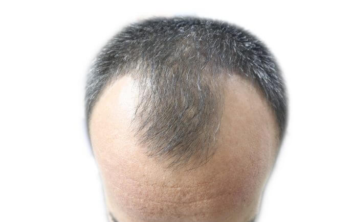 What is an M-Shaped Hairline