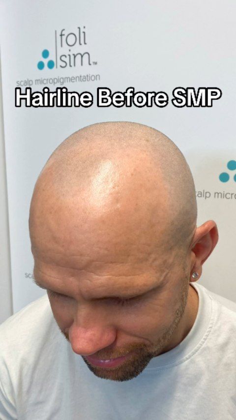 hairline tattoo -scalp micropigmentation Toronto – hair tattoo –  micropigmentation scalp | Hair Loss Clinic | PRP, Laser Light Therapy Men &  Women